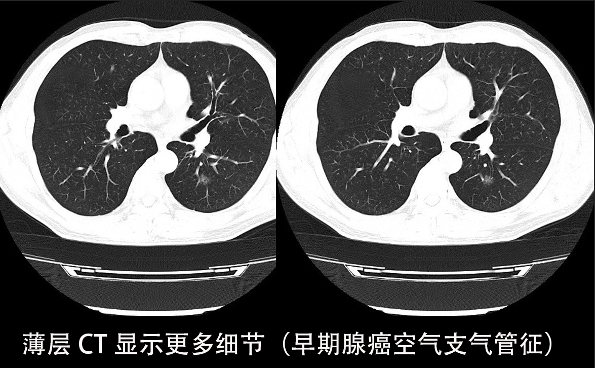 “肺常完美”--胸部CT检查该如何选择
