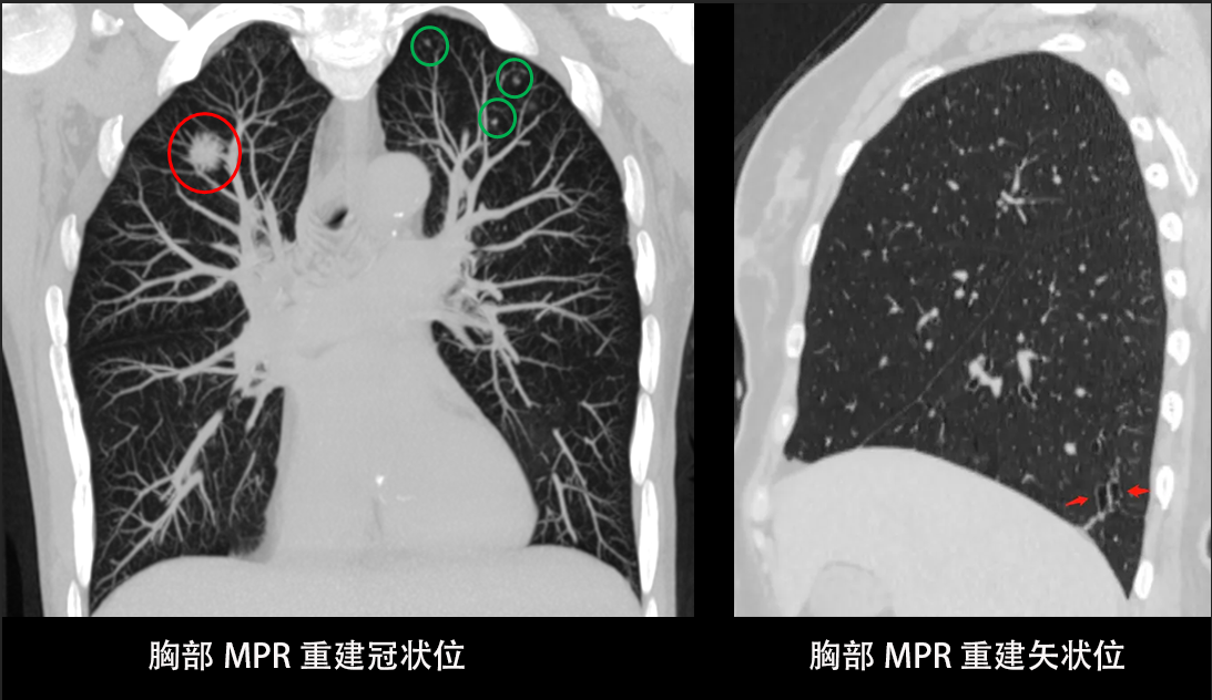 “肺常完美”--胸部CT检查该如何选择